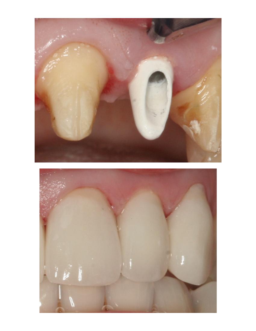Anterior implant and porcelain crowns — before or clinical case image
