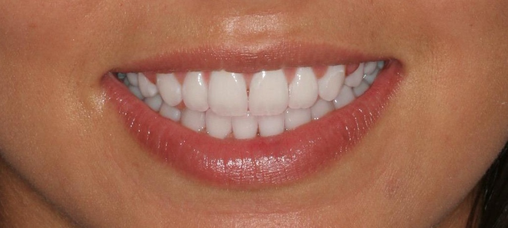 After professional teeth whitening