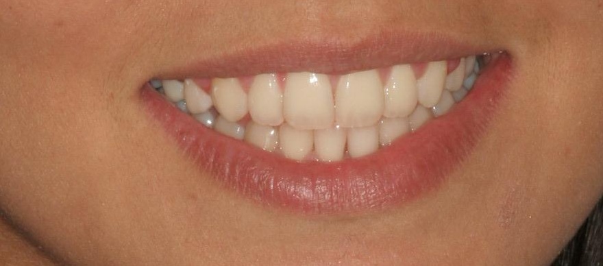 Before professional teeth whitening