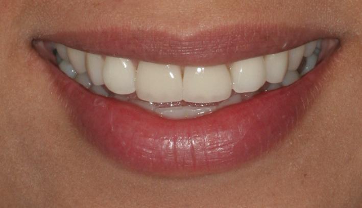 Smile makeover with porcelain crowns — after result