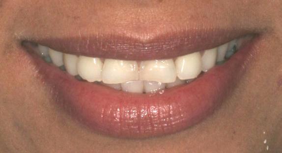 Smile makeover with porcelain crowns — before or clinical case image