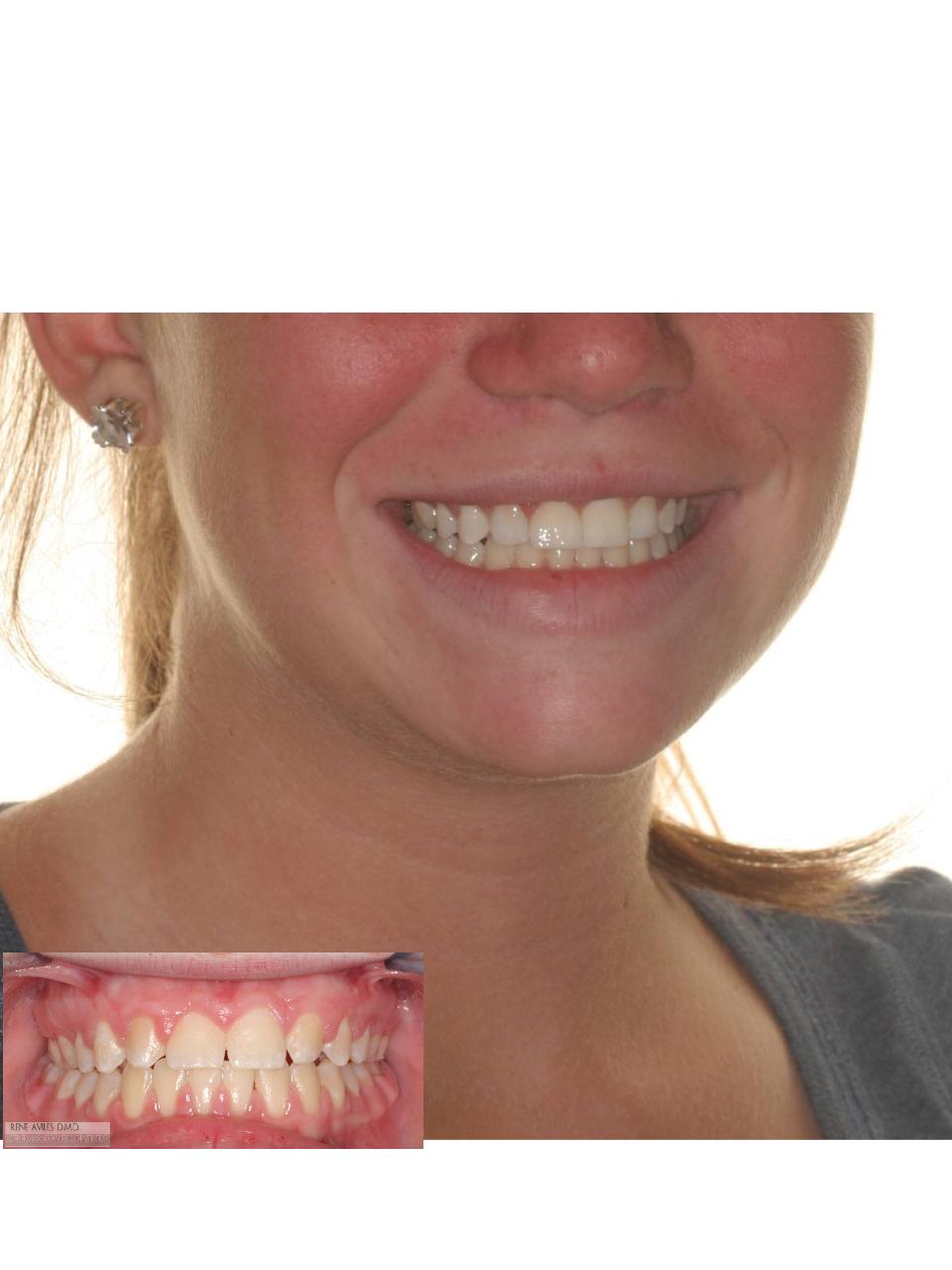 Smile makeover with tooth-color bondings — before or clinical case image