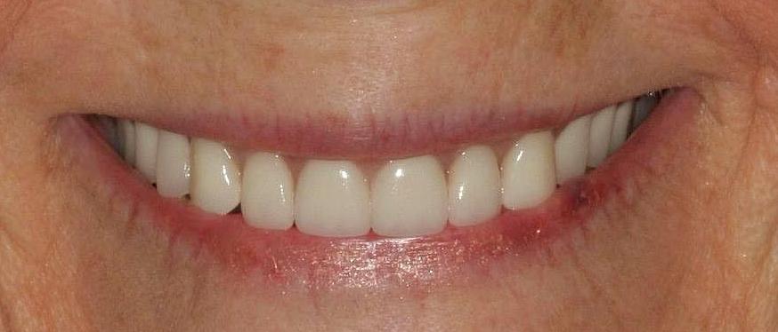 Improved smile with new dentures — after result