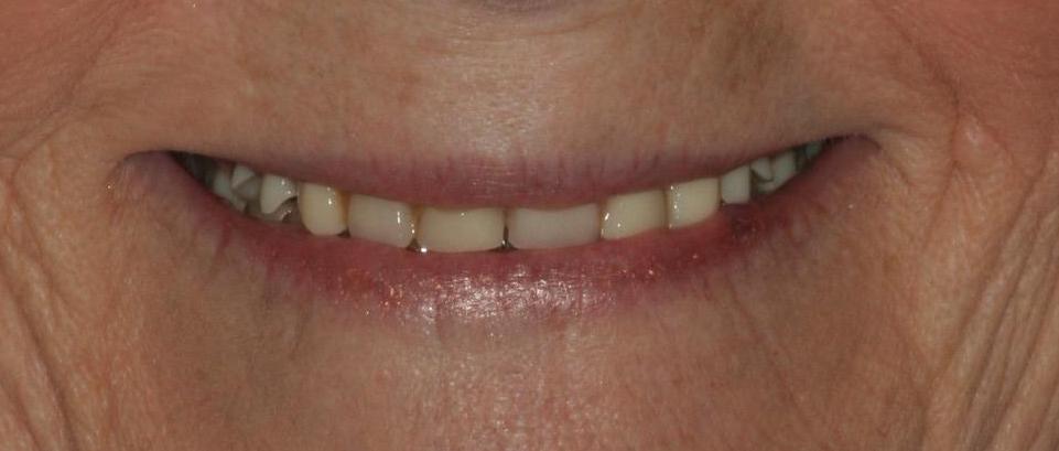 Improved smile with new dentures — before or clinical case image