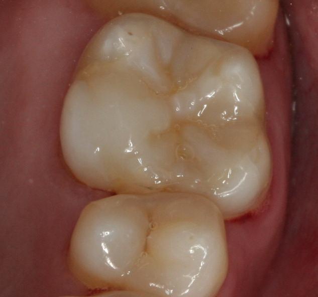 Porcelain Onlay — before or clinical case image
