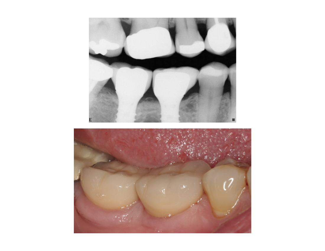 Posterior implants — before or clinical case image