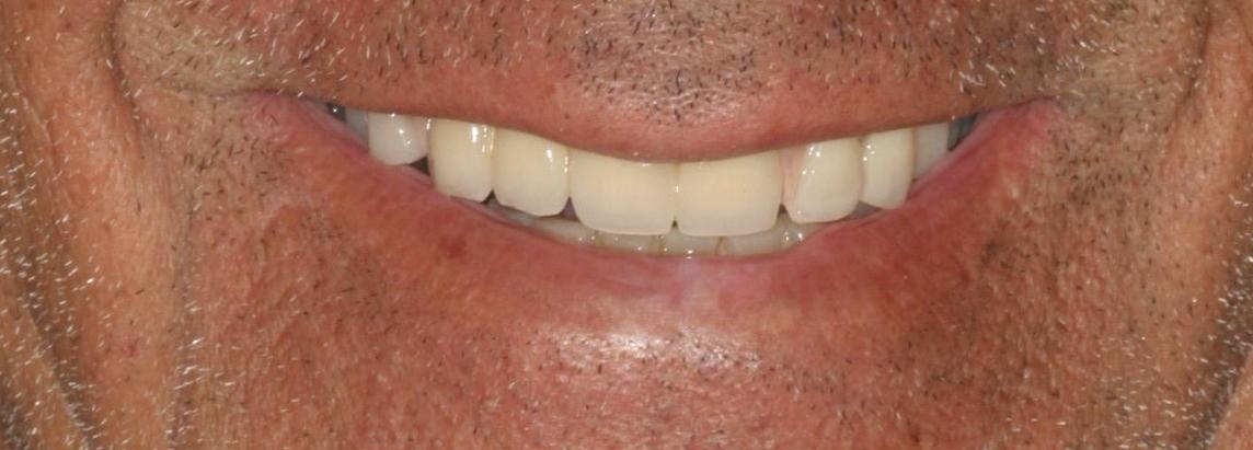 Smile makeover with crowns and partial dentures — after result