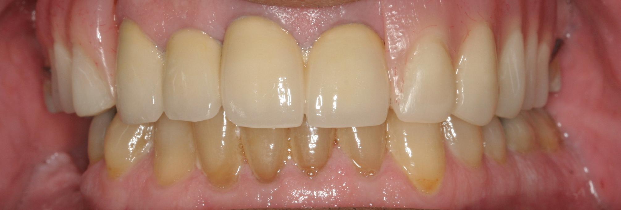 Retracted view of precision partial denture restoration showing anatomical bite alignment