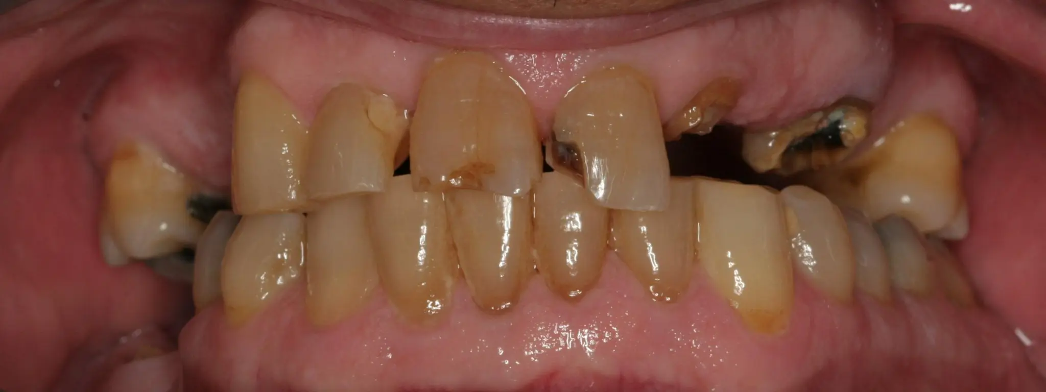 Smile makeover with crowns and partial dentures — before or clinical case image