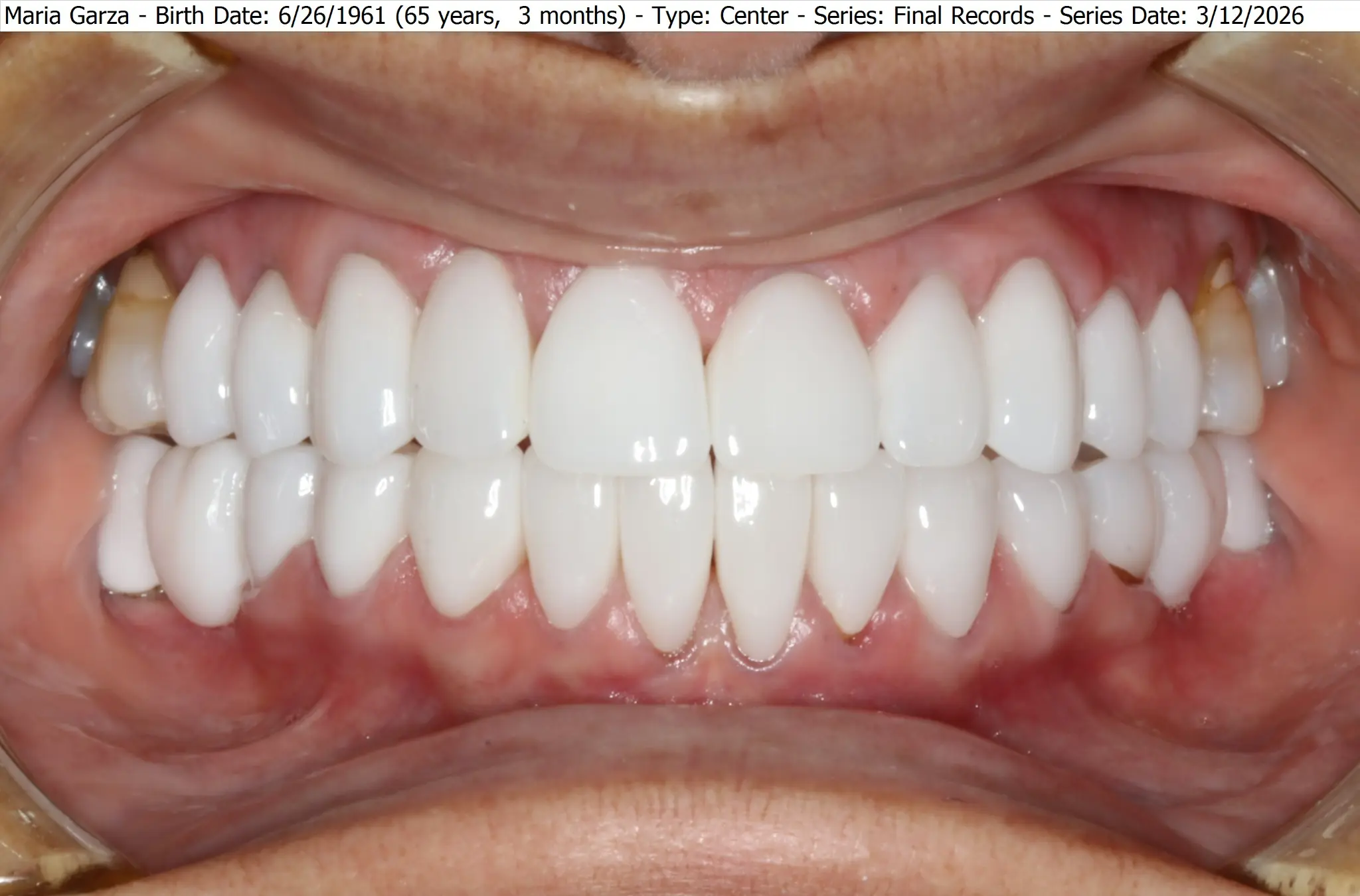 Full mouth rehabilitation intraoral records — after result