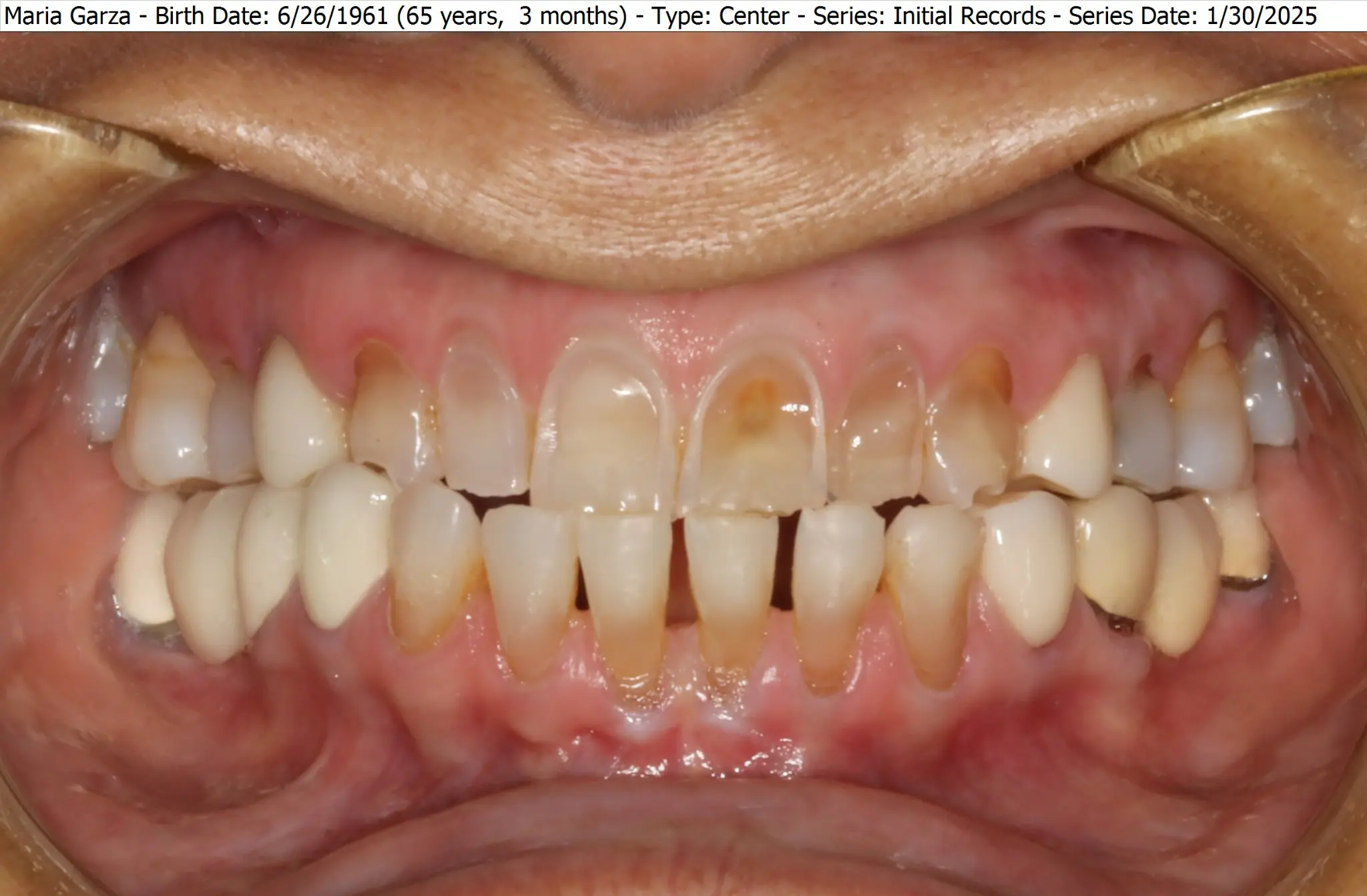 Full mouth rehabilitation intraoral records — before or clinical case image