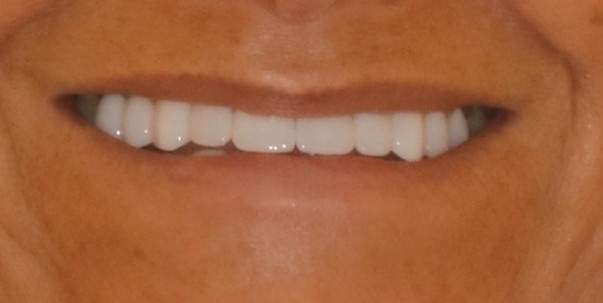 After full mouth rehabilitation smile