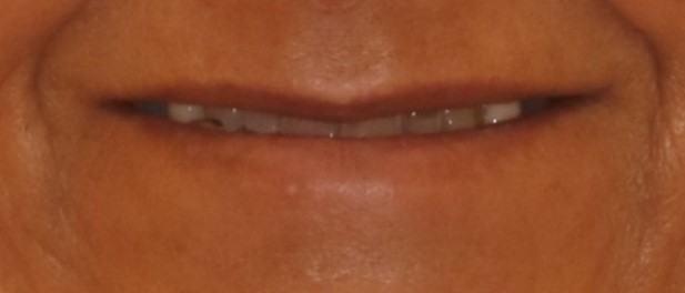 Before full mouth rehabilitation smile