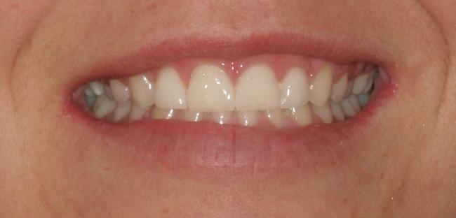 After porcelain veneer smile makeover