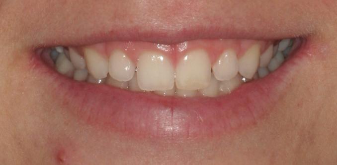 Before porcelain veneer smile makeover