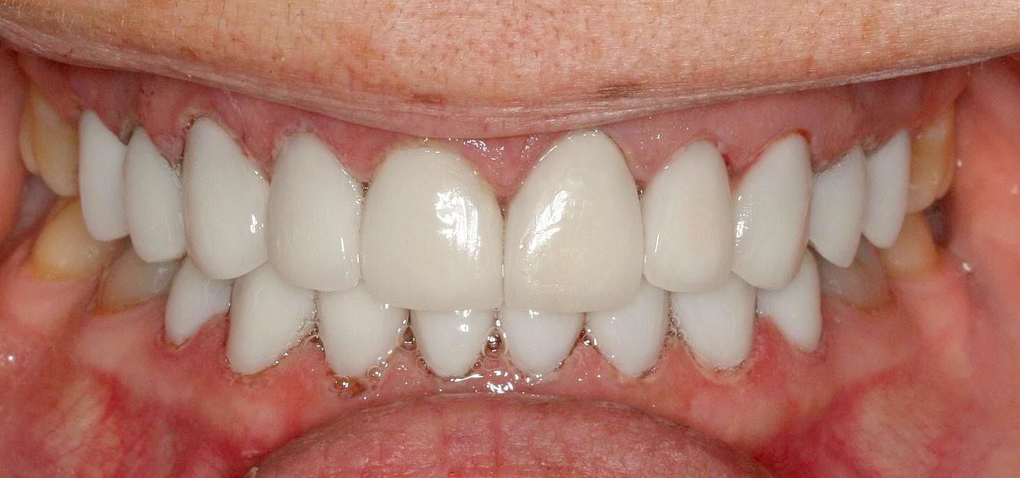 Smile makeover with veneers — after result