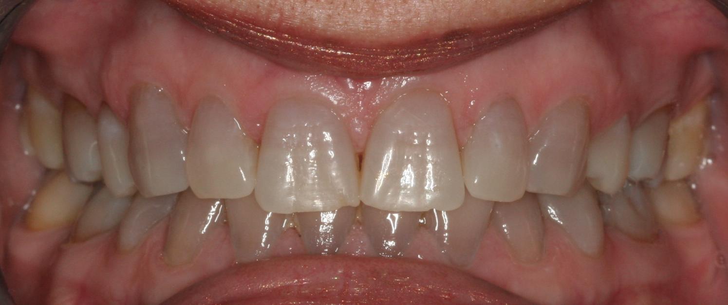 Smile makeover with veneers — before or clinical case image