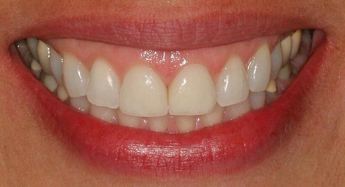 Smile makeover with veneers — after result