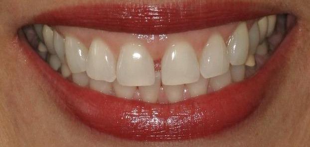 Smile makeover with veneers — before or clinical case image